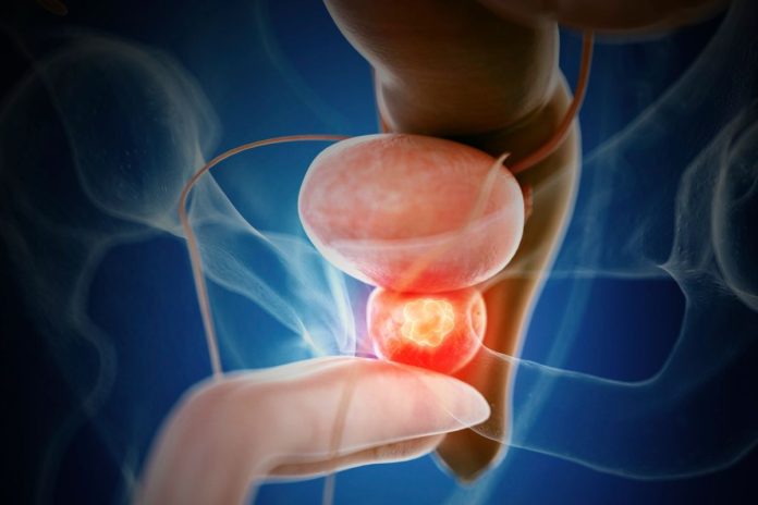 Cáncer de próstata: Cómo la tecnología médica puede ayudar a salvar vidas