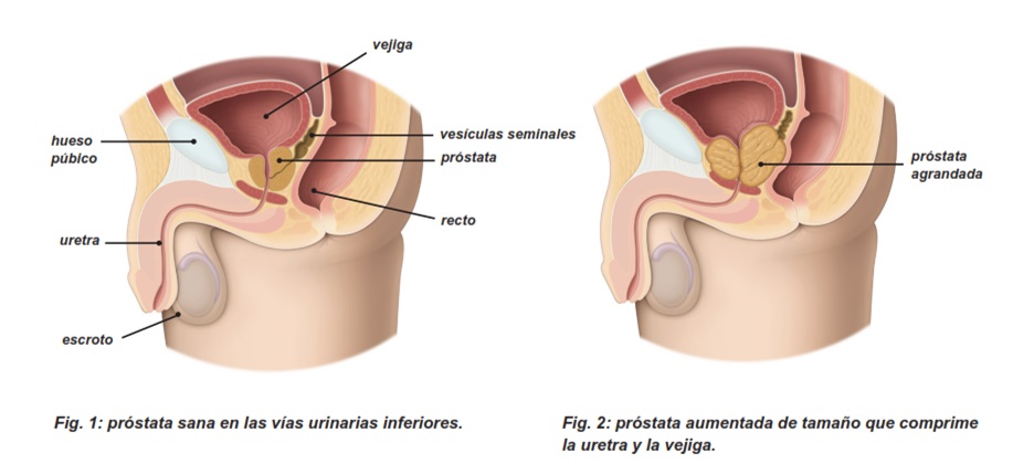 prostata-agrandada