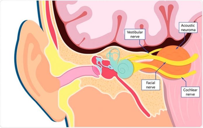 Tratamiento de Tumores Cerebrales con Radiocirugía