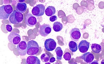 Mayo Clinic: Lo que se avista en el horizonte del mieloma múltiple y otros tipos de cáncer de la sangre