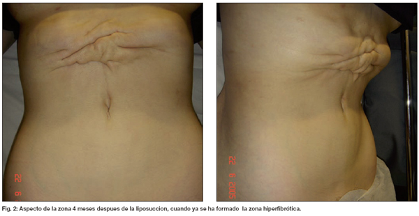 Hiperfibrosis tardía