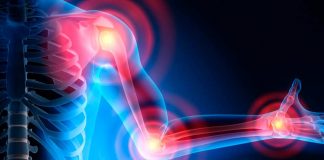Investigadores de Mayo desarrollan algoritmo para predecir actividad de la artritis reumatoide