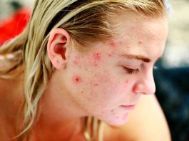 El verano empeora enfermedades de la piel