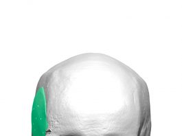 Startup chilena desarrolla implantes cráneo-faciales customizados con tecnología única