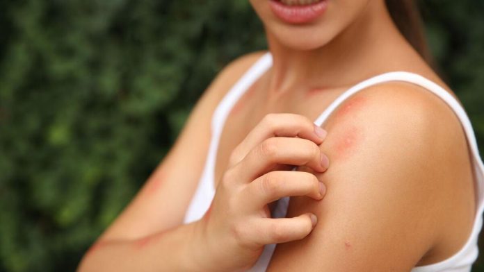 Verano, picaduras y cómo lidiar con ellas