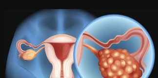 Investigadores de Mayo Clinic vinculan el cáncer de ovario con la colonización bacteriana en el microbioma
