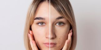 Hiperpigmentación: cómo disminuir las manchas en la piel