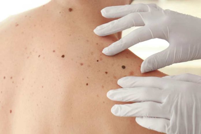 Cirugía de Mohs ¿en qué consiste la técnica que permite tratar el cáncer de piel
